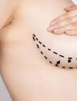 “Meme dikleştirme, ciddi bir estetik operasyondur”