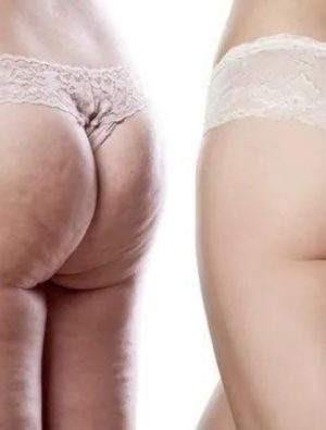 Lipödem yaz aylarında tetikleniyor