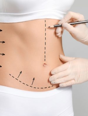 Karın germe estetiği kilo vermek için yapılmıyor