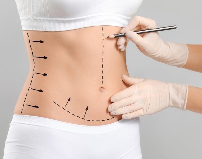 Karın germe estetiği kilo vermek için yapılmıyor