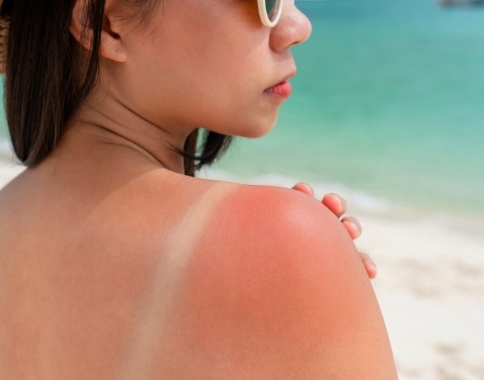 Cilt kanserinden korunmak için 5 kritik kural!