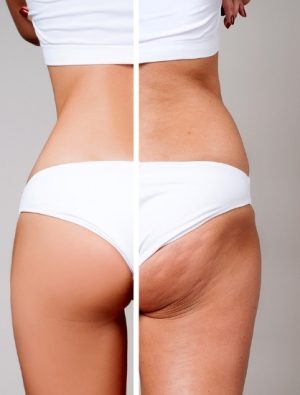 Aldığınız kilolar sadece bacak ve kollarınızda birikiyorsa…