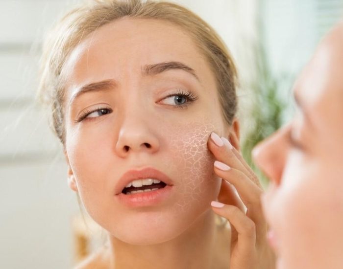 Ciltte kuruluk, kızarıklık, lekelenme ve akne oluşabilir!