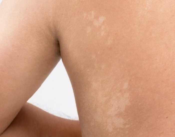 Tinea Versikolor: Lekeleri Güneş Yanığı Sanmayın